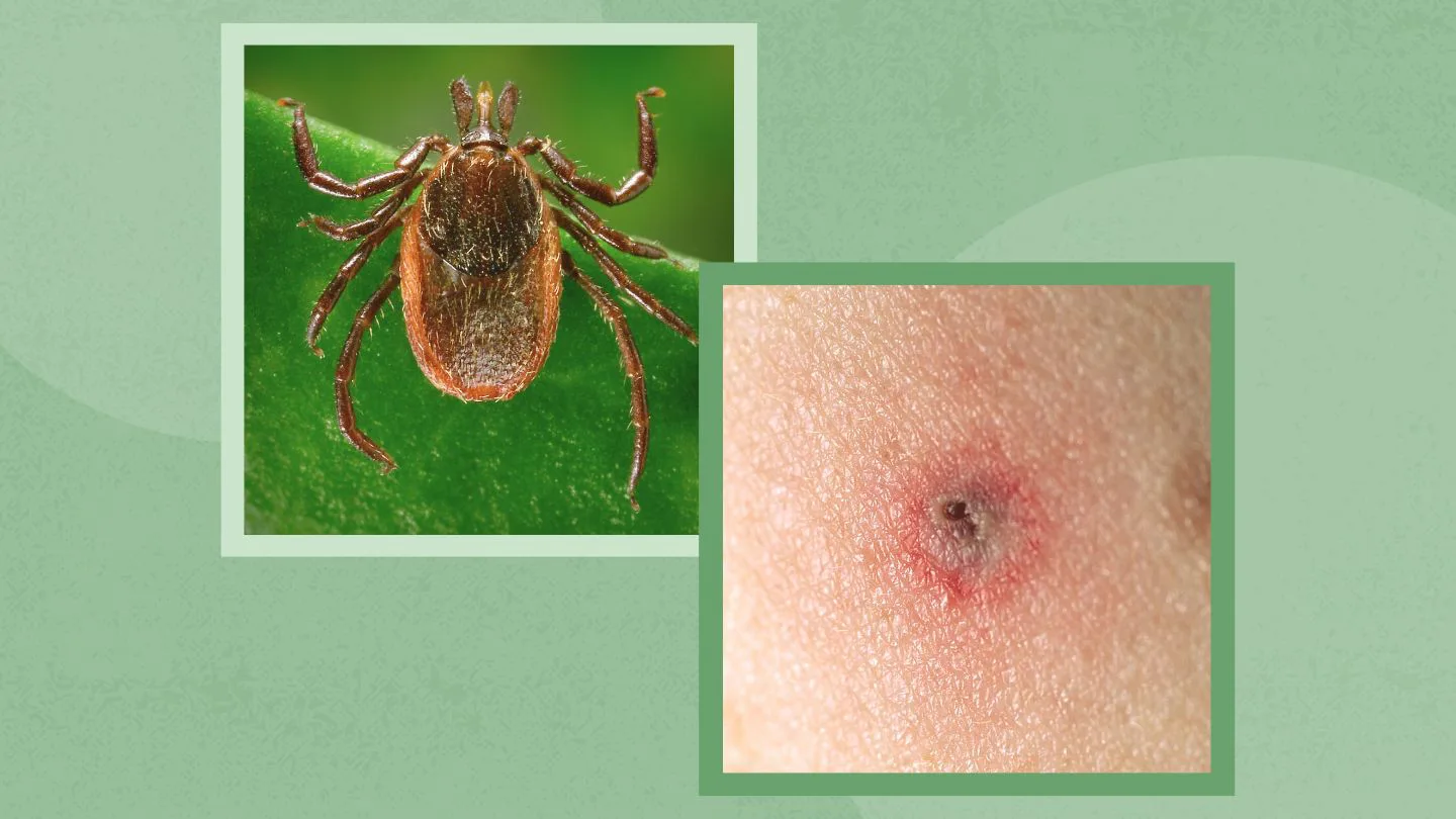 Emerging Tick Bite-Associated Meat Allergy